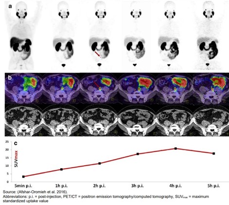 Sequential PET CT of a Patient Following the Injection of 170 MBq 68Ga-PSMA-11