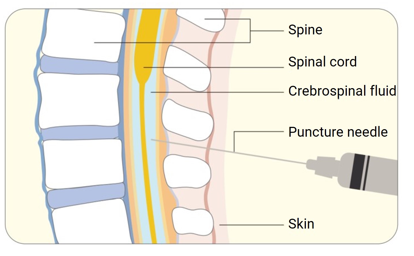 Sites of intrathecal injection