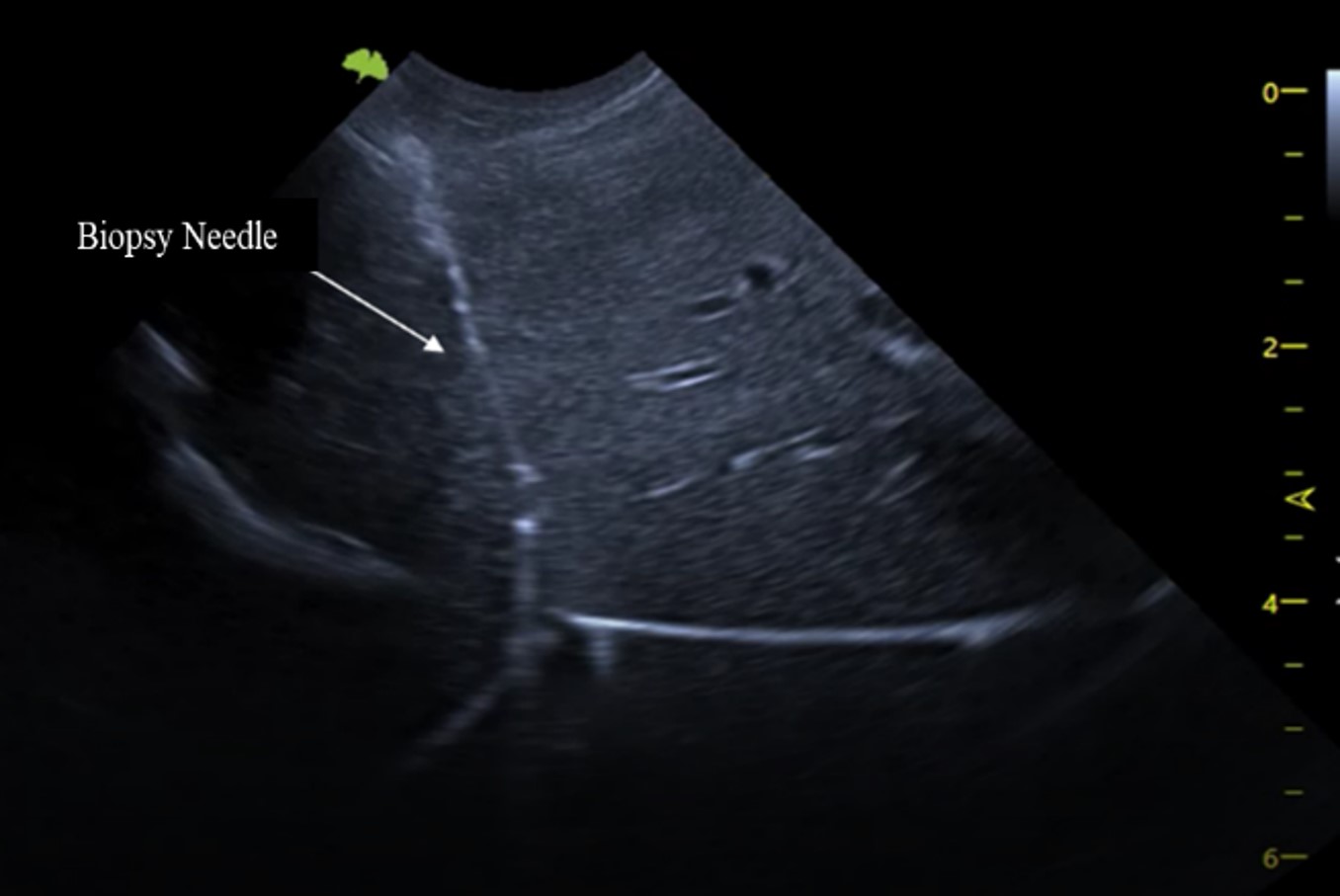 Ultrasound-guided biopsy monitor display with a biopsy needle