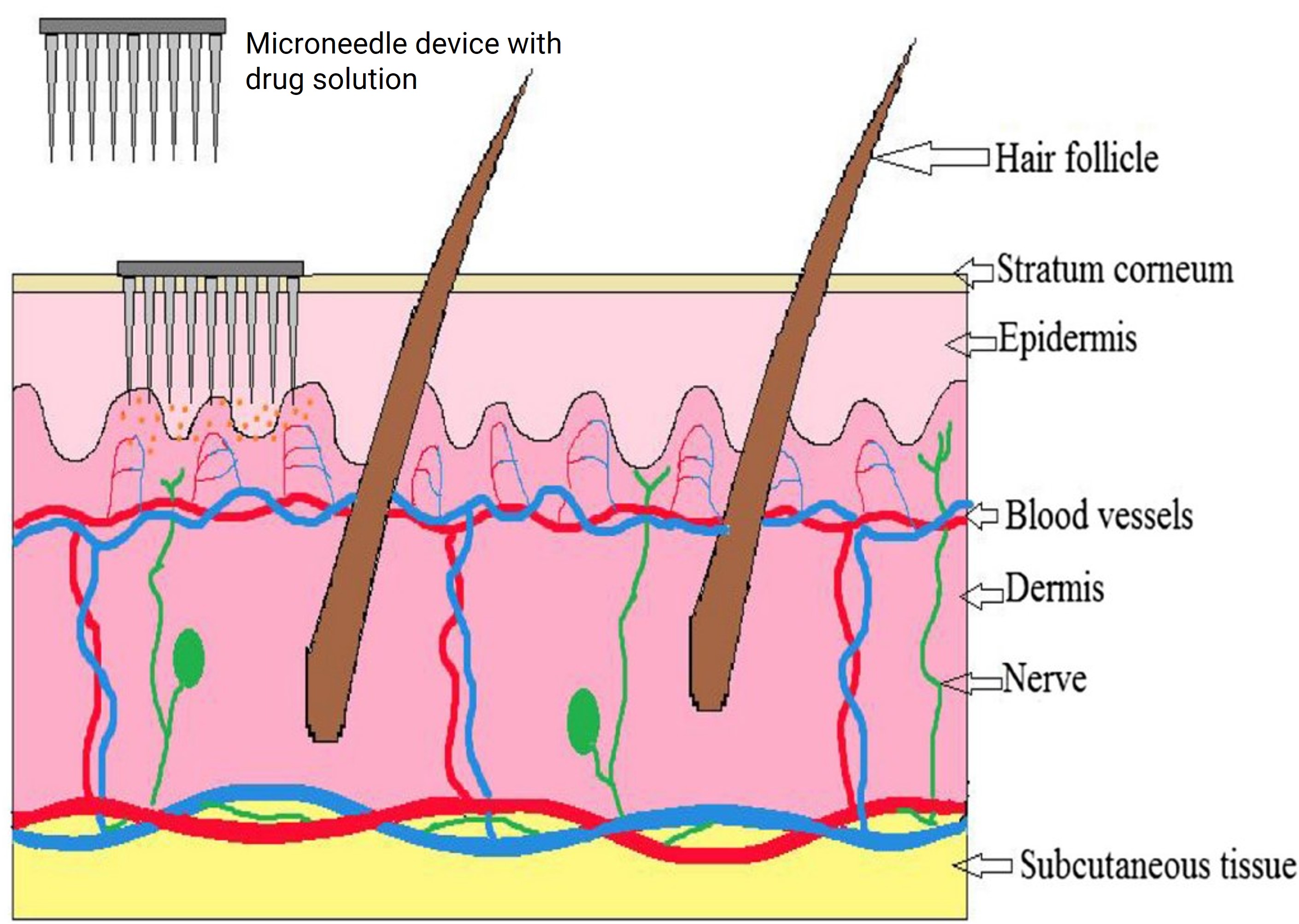 Mechanism of drug delivery by microneedle device