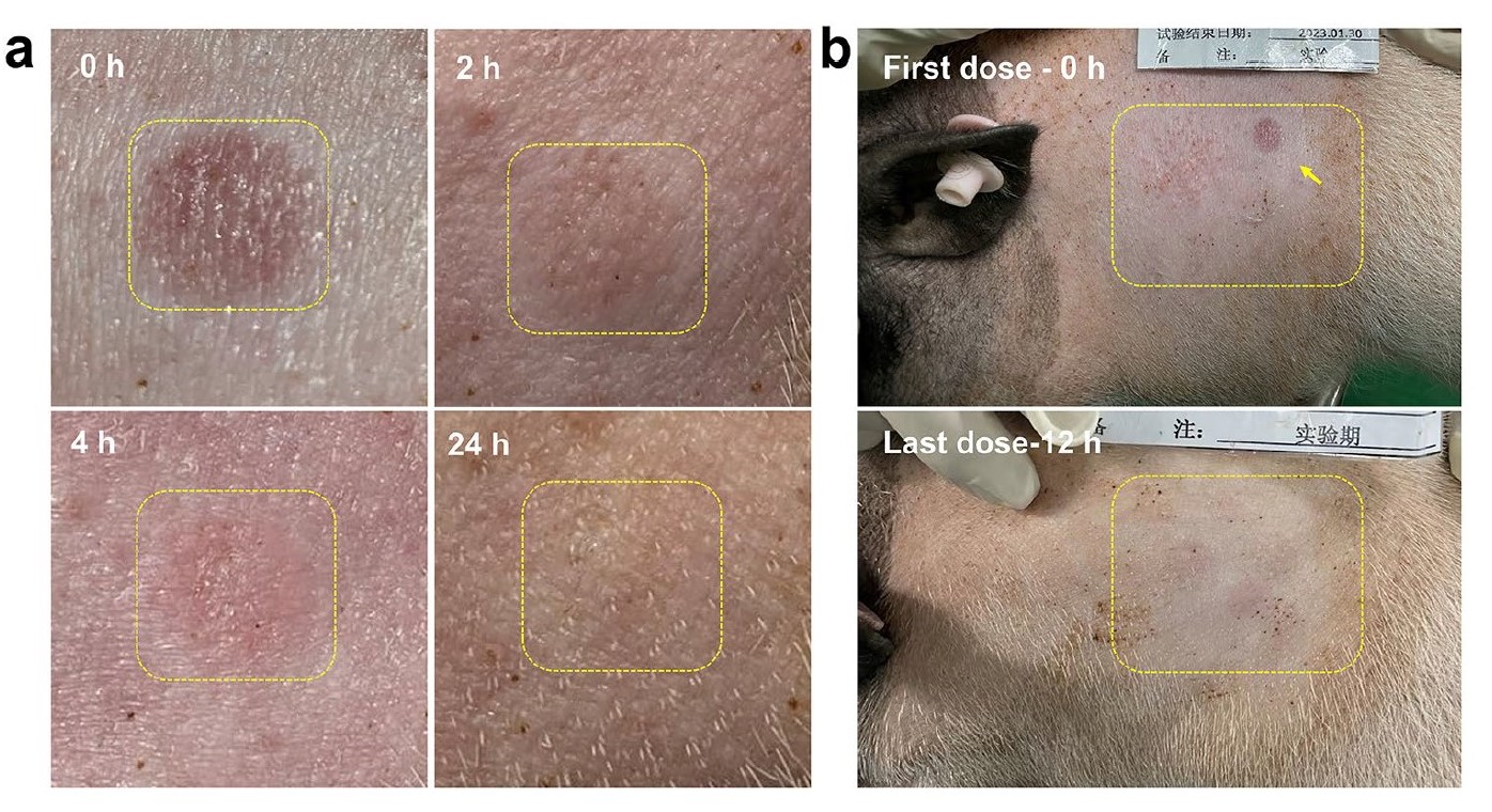 Skin irritation after application of dissolvable liraglutide microneedles to minipigs